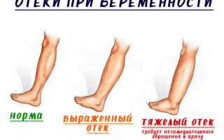 Отеки при беременности: причины и рекомендации