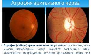 Лечение атрофии зрительного нерва: методы и рекомендации