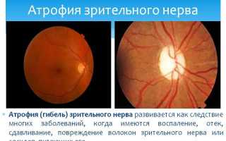 Лечение атрофии зрительного нерва: методы и рекомендации
