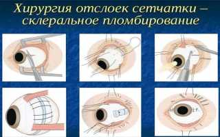 Основные виды и методы оперативного вмешательства при лечении заболеваний глаз: полное руководство