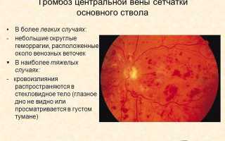Тромб в глазу – лечение тромбоза центральной вены сетчатки и его последствия