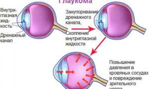 Компьютерная периметрия для диагностики заболеваний зрения