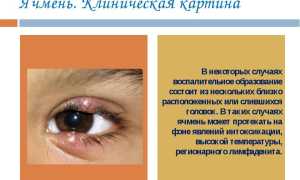 Ячмень: причины, симптоматика, лечение и профилактика