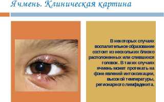 Ячмень: причины, симптоматика, лечение и профилактика