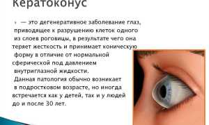 Симптомы, причины возникновения и лечение кератоконуса у пациентов