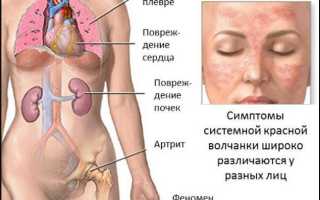 Системная красная волчанка: что делать если есть признаки болезни?