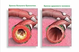 Бронхи при бронхите