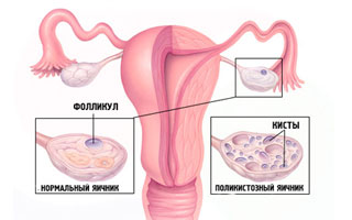 Нормальный яичник и поликистозный Схема строения мочеполовой системы