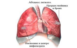 Рисунок абсцесса легкого