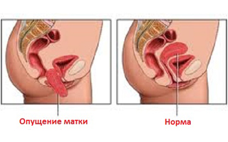 Причина недержания