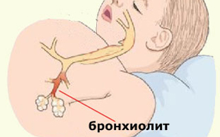 Бронхит 