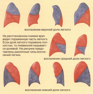 Пневмония 