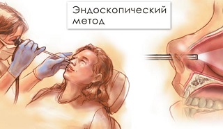 Эндоскопический метод Эндоскопический метод