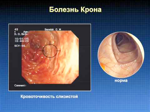 Диагностика болезни крона