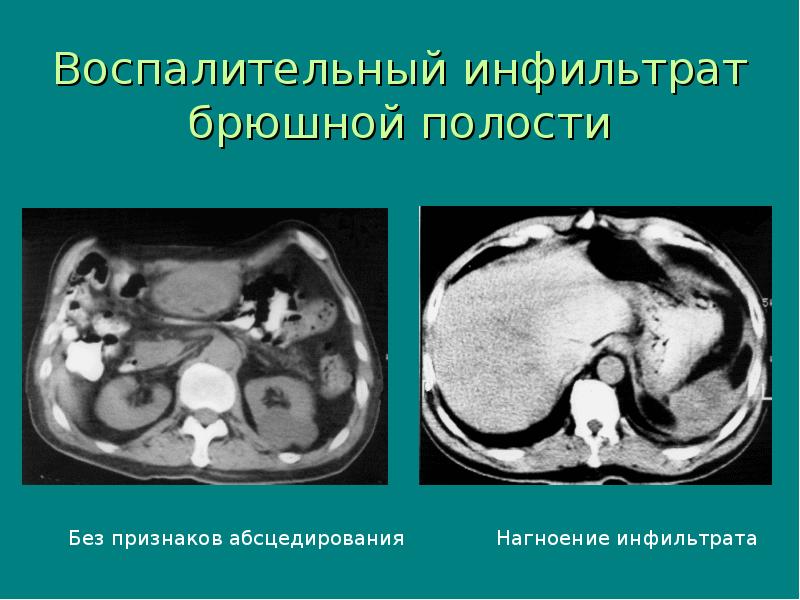 Инфильтрат брюшной полости Инфильтрат