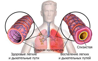 Легочные осложнения