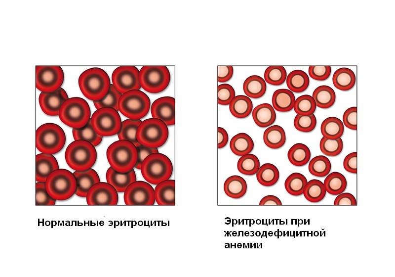 При анемии