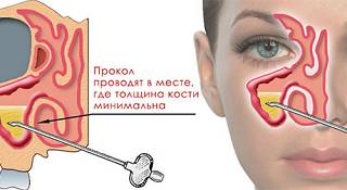 Прокол при гайморите Прокол при гайморите