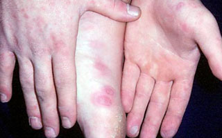 Избегаем контакта с больным или вирусоносителем Причины болезни