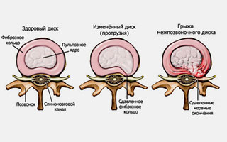Межпозвоночная грыжа Схема развития межпозвоночной грыжи