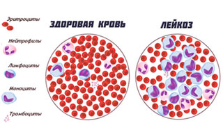 Клетки здоровой крови и при лейкозе
