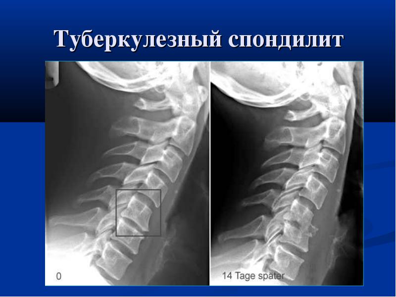 Туберкулез позвоночника