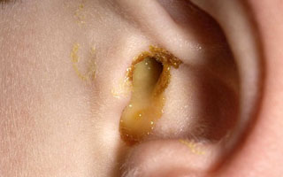 Из уха течет гной Симптомы болезни
