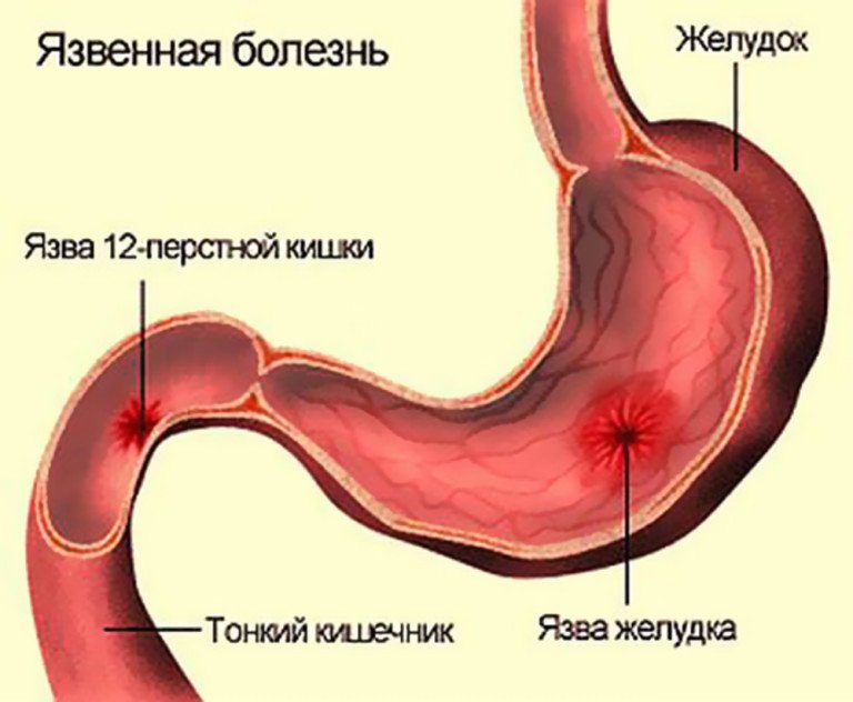 Язва желудка и двенадцатиперстной кишки