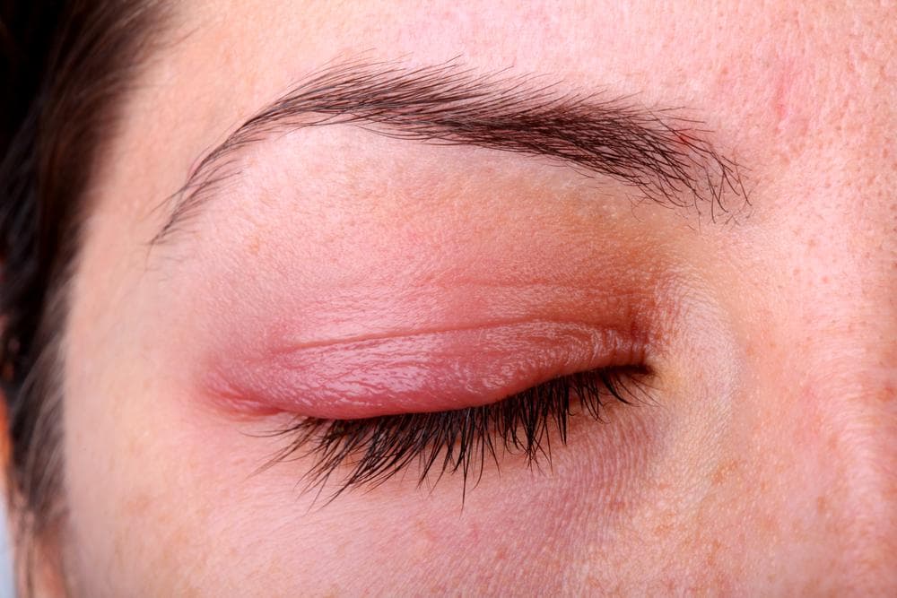 02eyehealthdisease_blepharitisgraphic