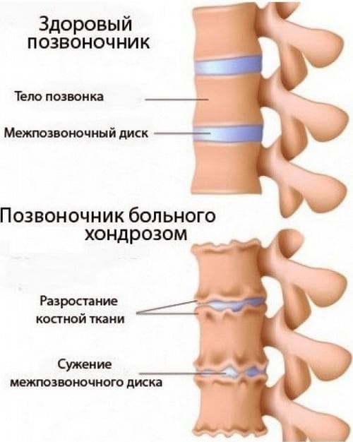 Проявление шейного остеохондроза