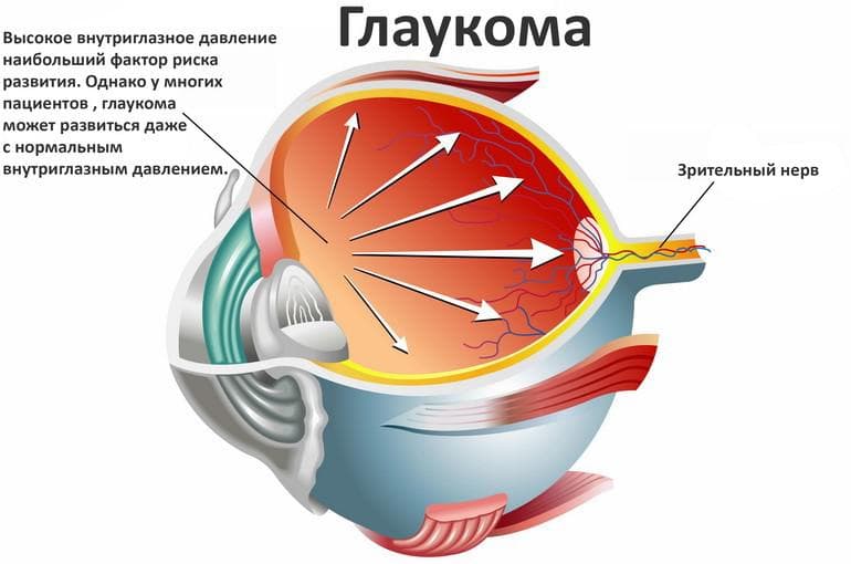 что такое глаукома