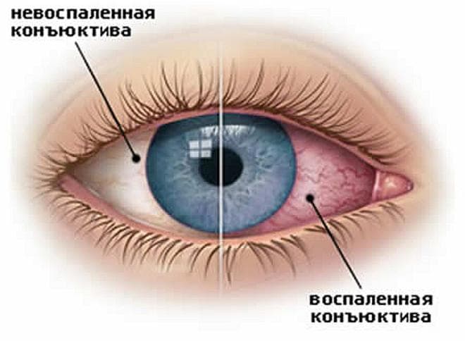 симптомы заболевания
