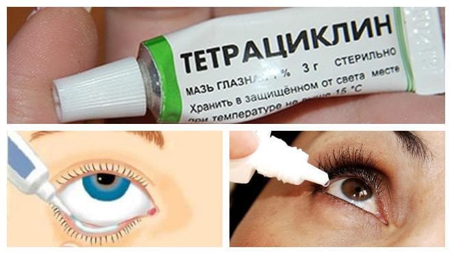 Тетрациклин используют для лечения ячменя