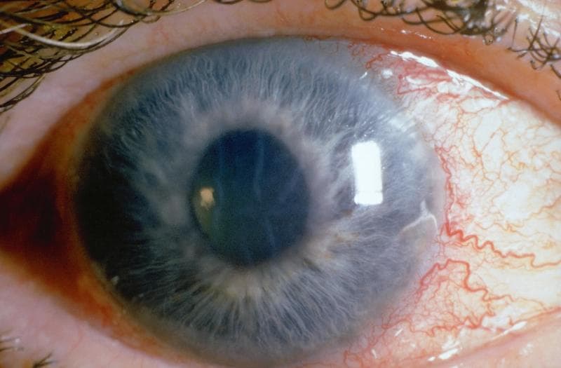 Eye of Patient with Acute Glaucoma