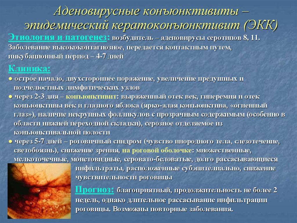 adenovirusnyj-keratokonyunktivit