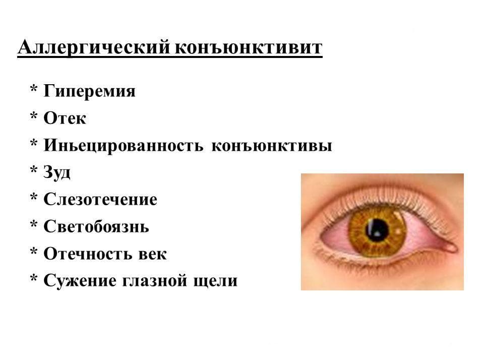 allergicheskij-konyunktivit