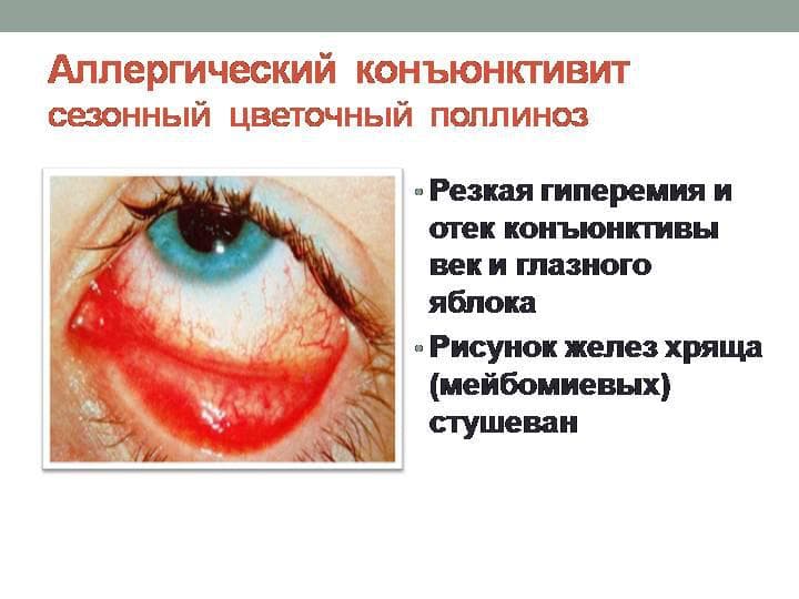 Аллергический конъюнктивит