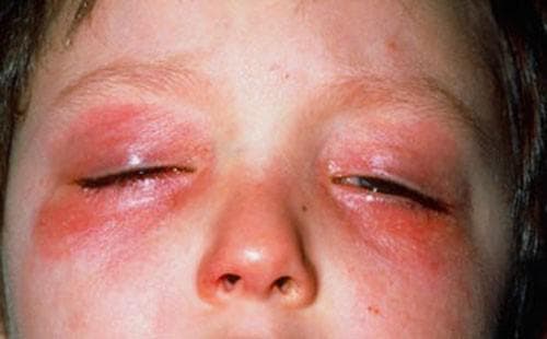 allergiya-na-glazax