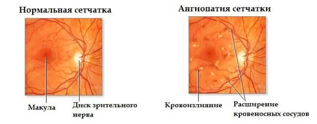 Ангиопатия