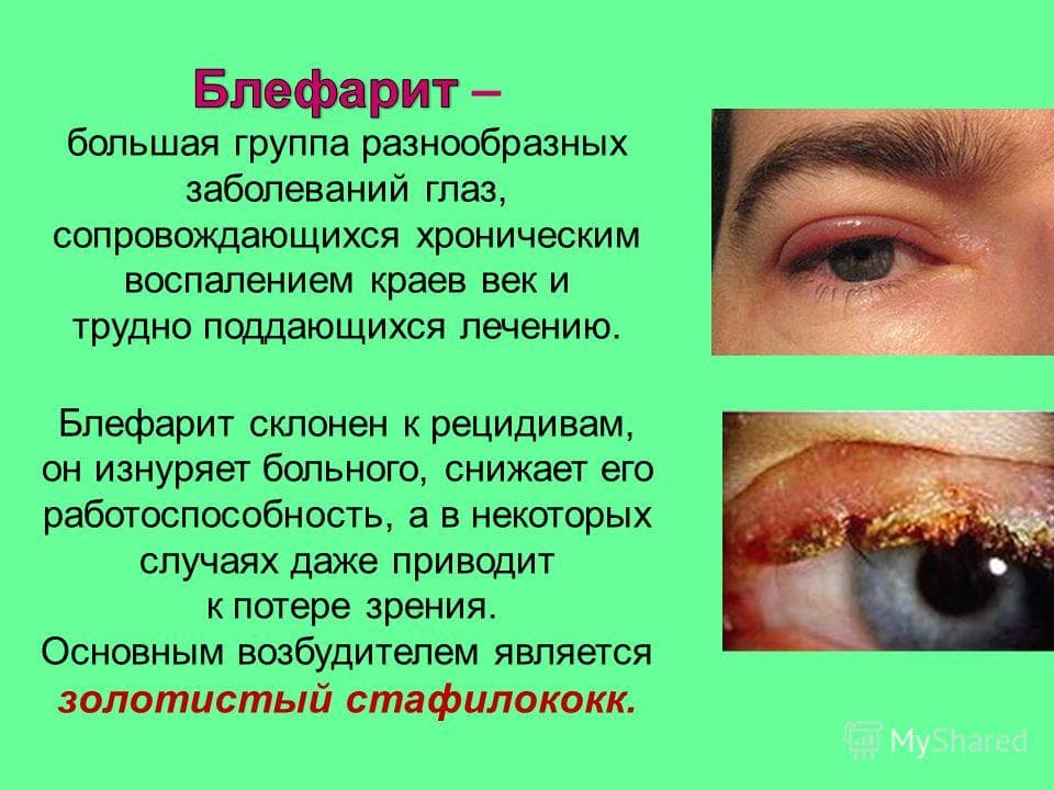 Блефарит
