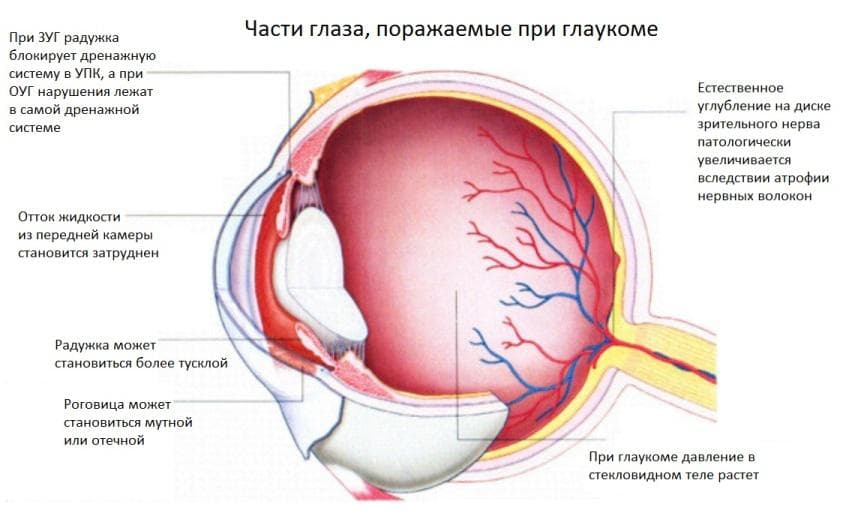 chasti-glaza-porazhaemye-glaukomoj