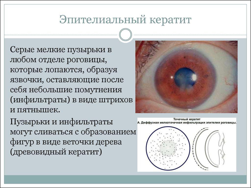 chto-takoe-epitelialnyj-keratit
