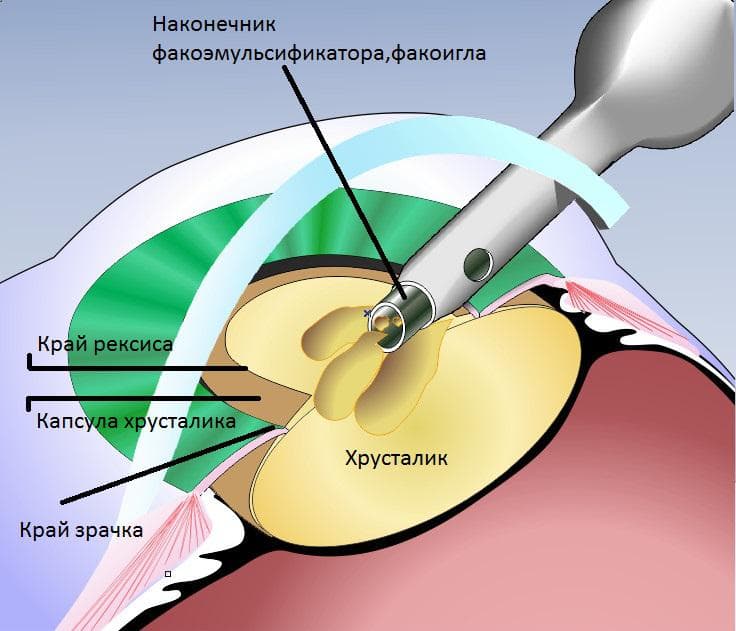 Экстракапсулярная операция