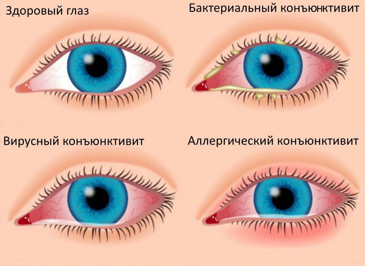 эписклерит, эписклерит симптомы и лечение, эписклерит глаза причины, эписклерит глаза фото, эписклерит лечение, эписклерит глаза, эписклерит причины заболевания,