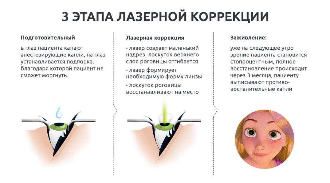 etapy-provedeniya-lazernoj-korrekcii