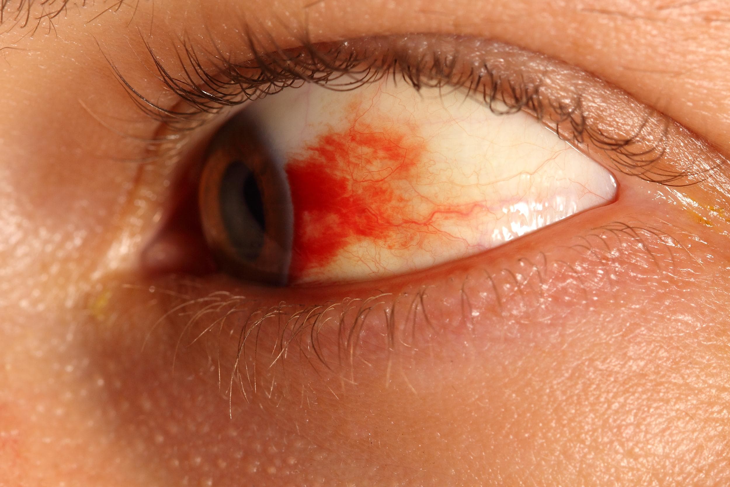 eye-retinopathy-bsc-1