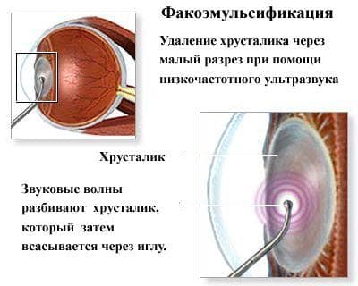 Факоэмульсификация катаракты - это операция с имплантацией, ультразвуковая, набор, послеоперационный период, ИОЛ, видео