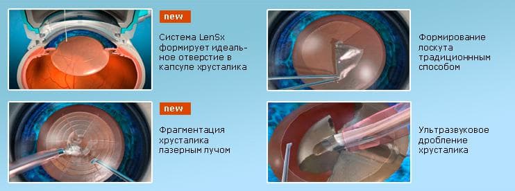 Катаракта: операция, реабилитация после, лечение и профилактика, какие работы запрещены, по удалению