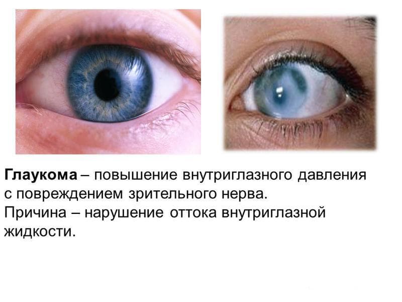 glaukoma