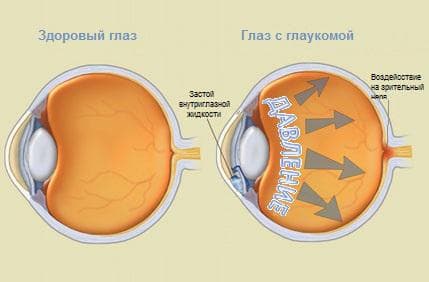 https://eyesdocs.ru/zabolevaniya/glaukoma/svoevremennoe-lechenie-glaukomy-put-k-xoroshemu-zreniyu.html